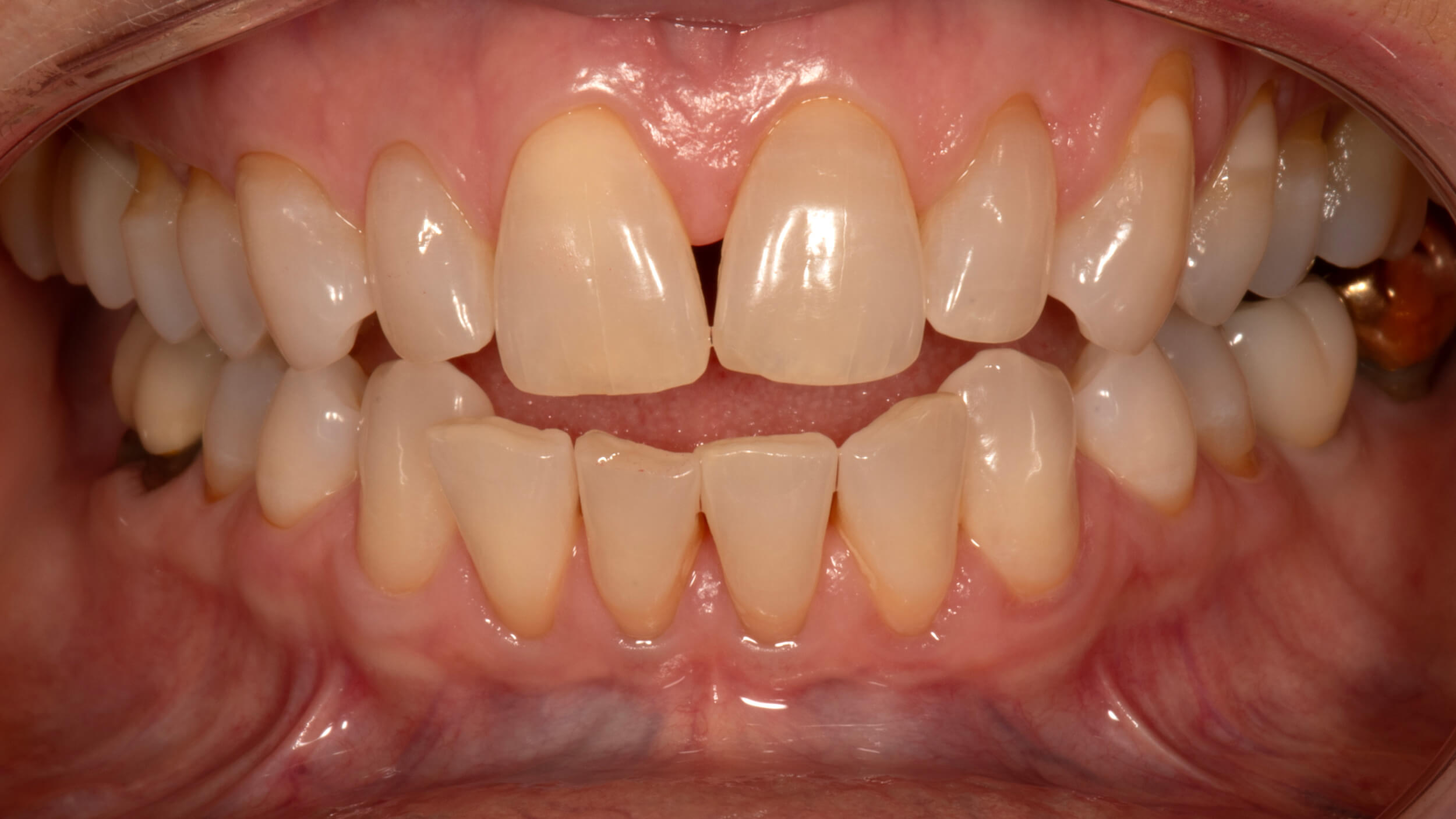 Crowns Case 8 