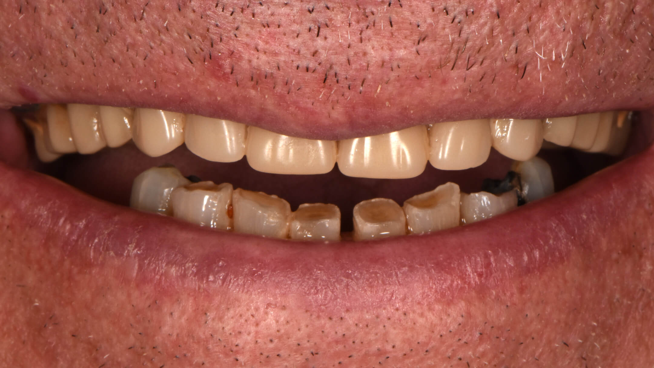 Dental Implants Case 1 Before