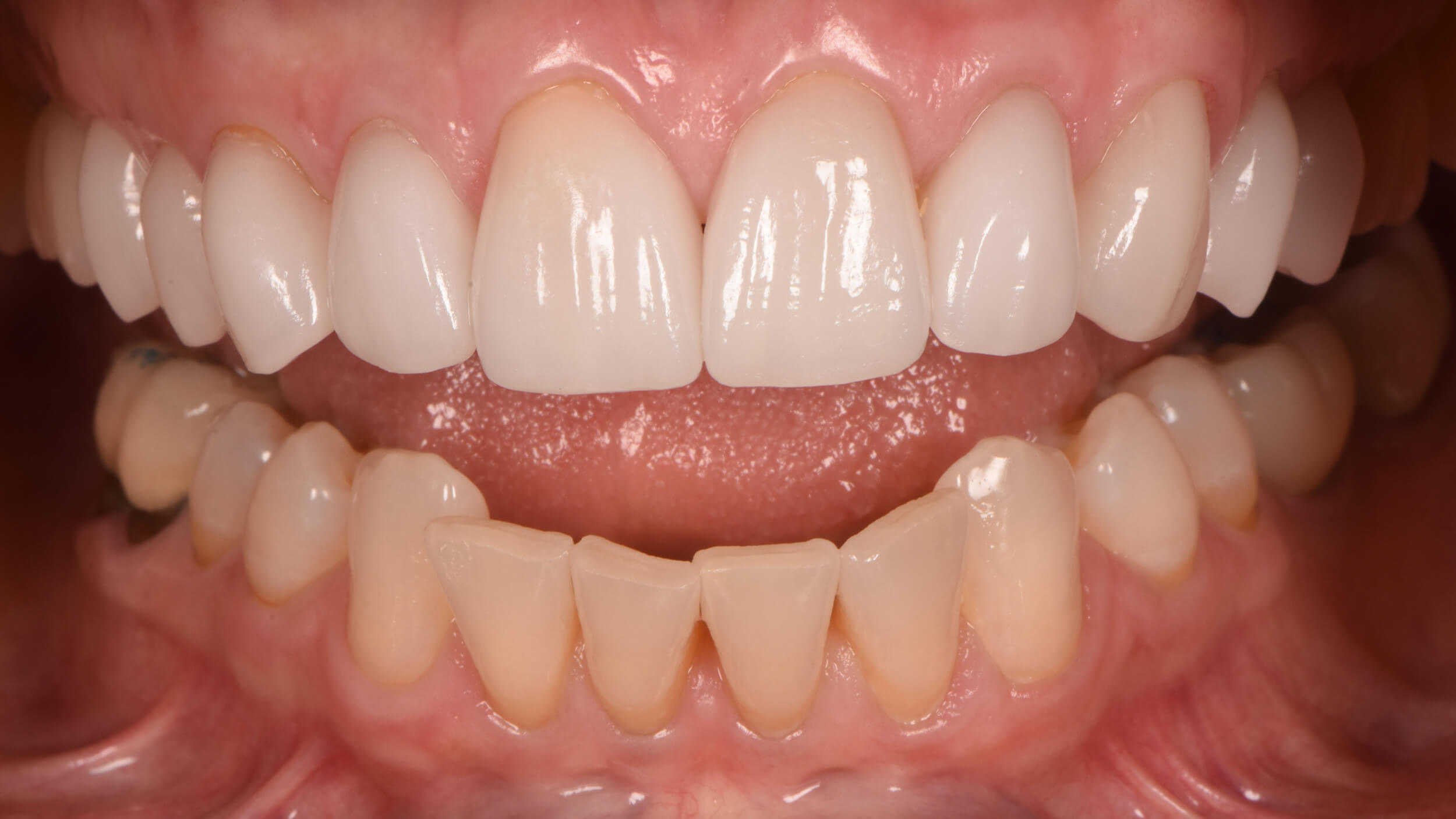 Crowns Case 8 