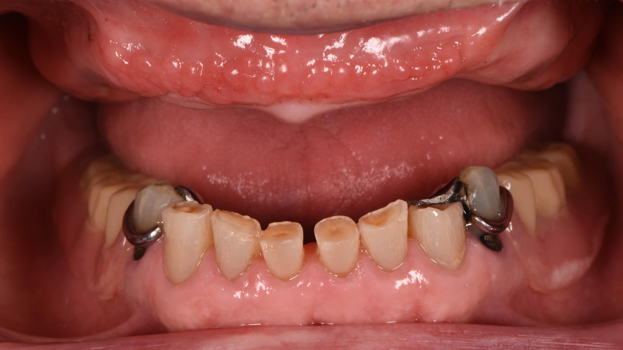 Dental Implants Case 1 Before