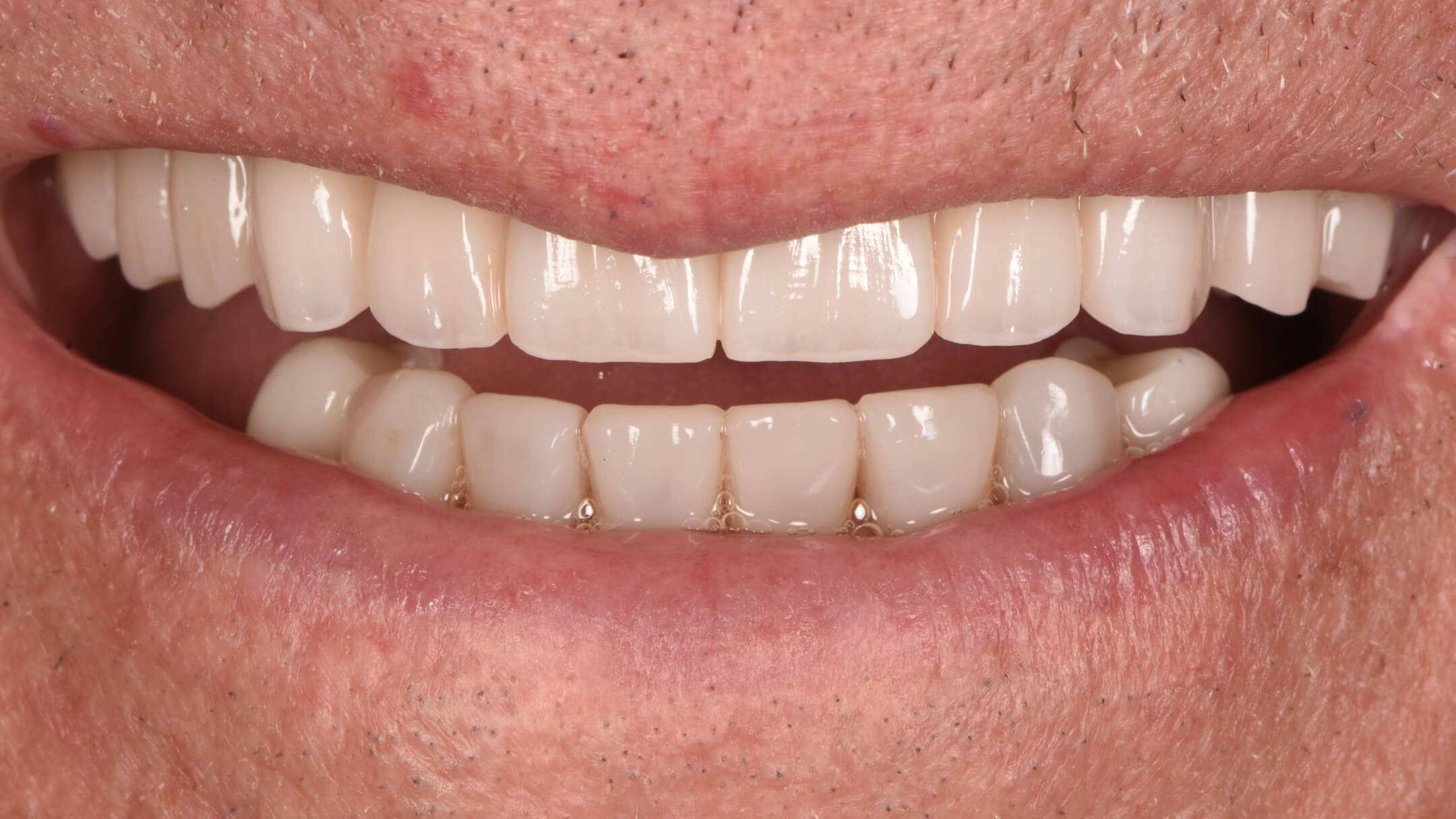 Dental Implants Case 1 After