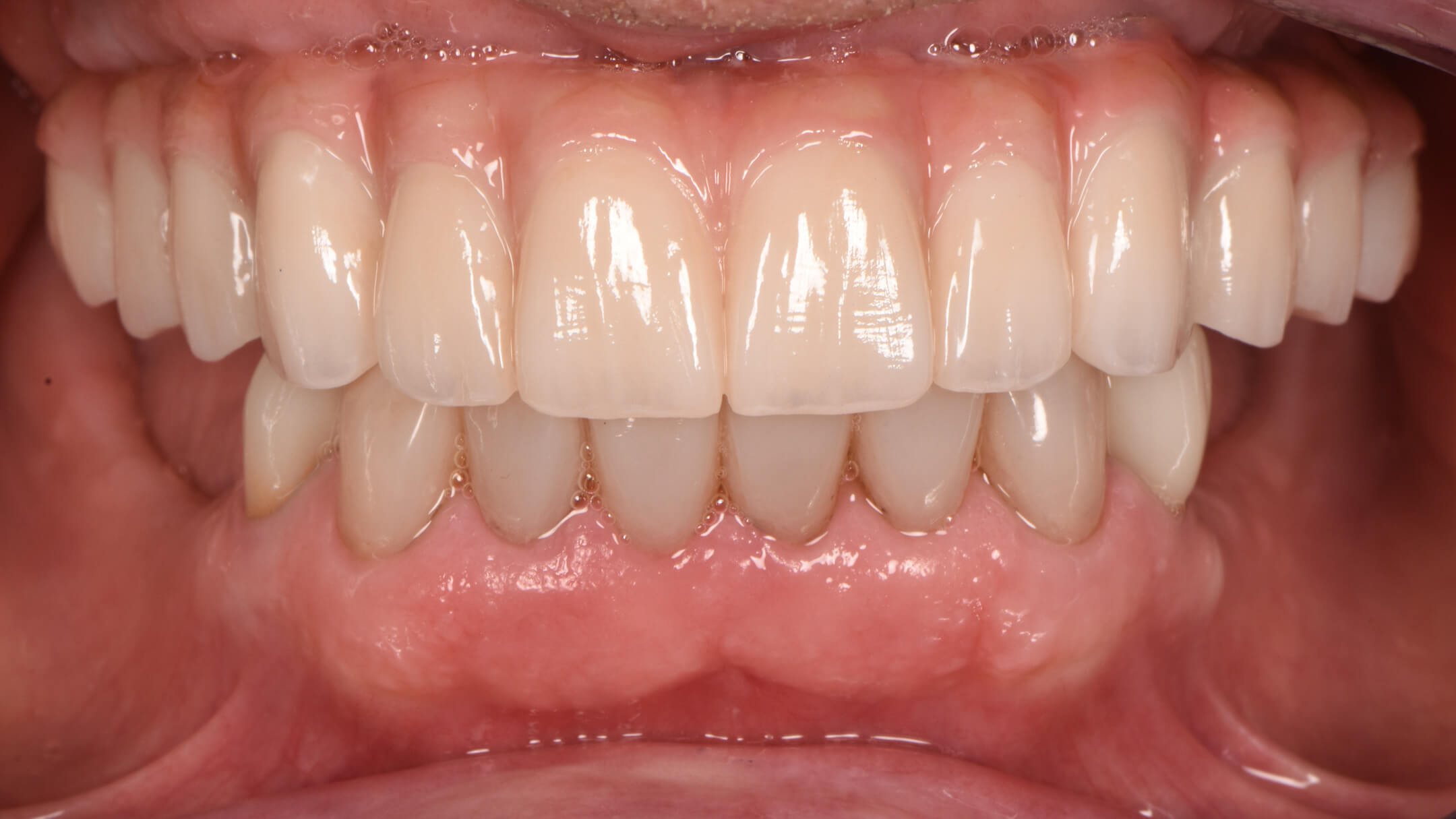 Dental Implants Case 1 After