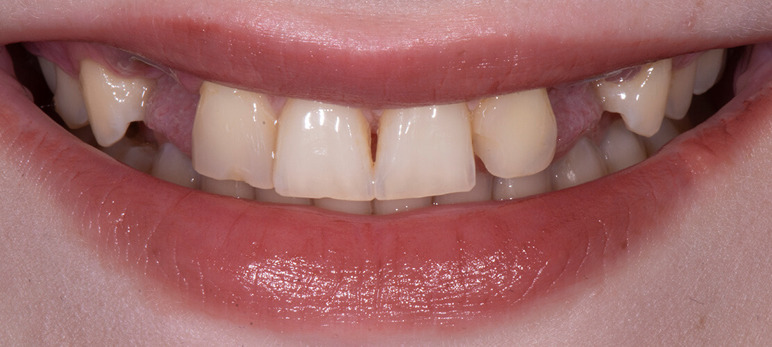 Dental Implants Case 5 