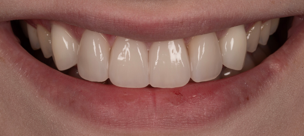 Dental Implants Case 5 