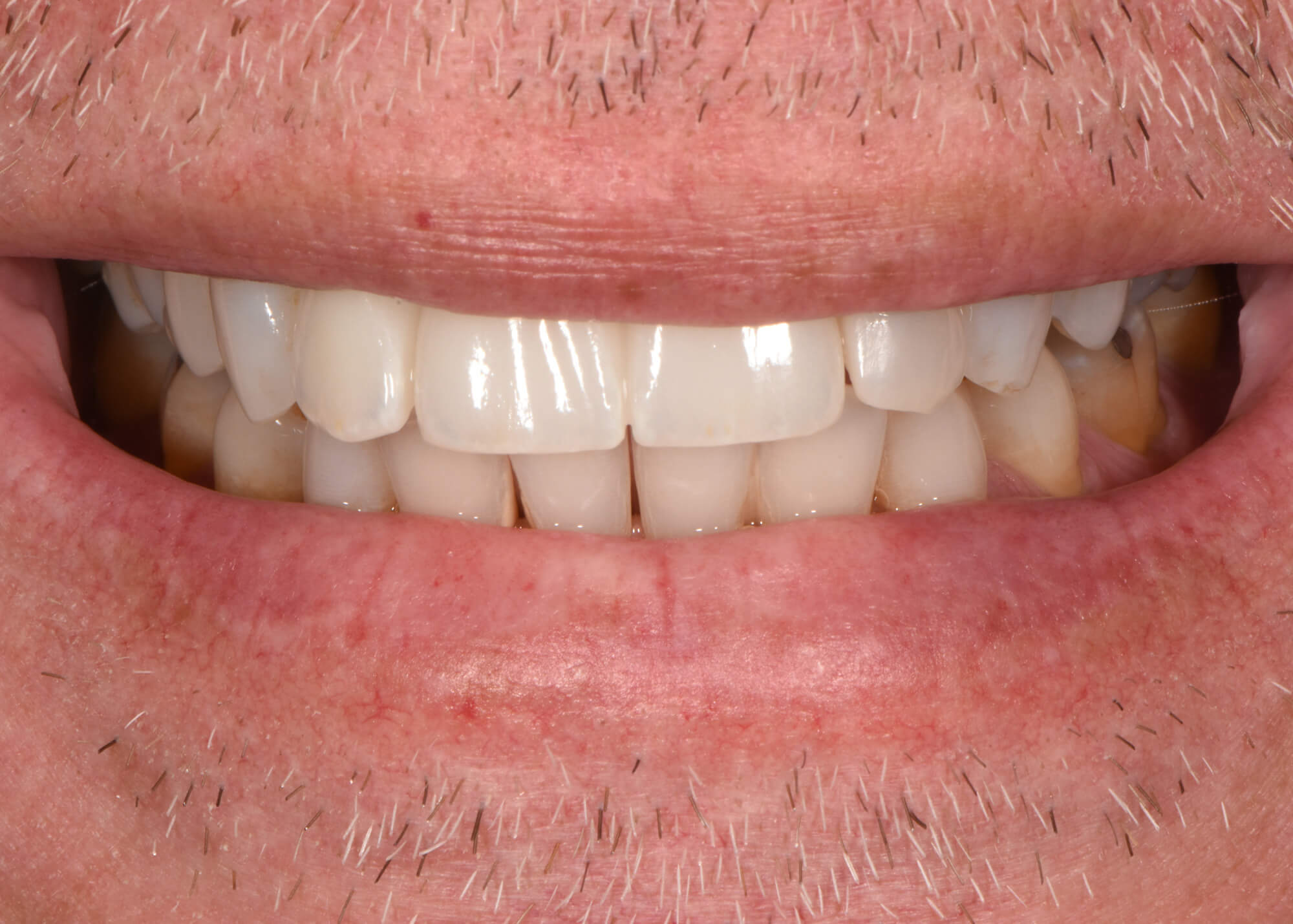 Dental Implants Case 4 